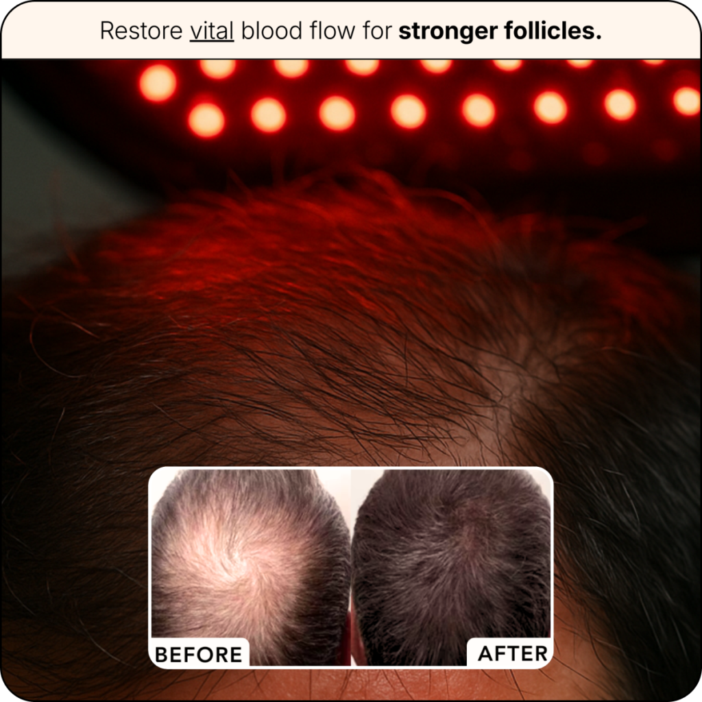 FolliGrow Reverse Hair Loss by Restoring Blood Flow & Energy to Your Follicles